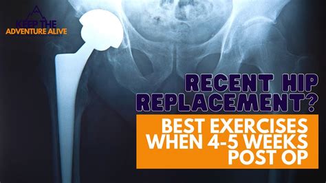 My Triumphant Journey to Recovery: How I Overcame the Challenges of a Hip Replacement